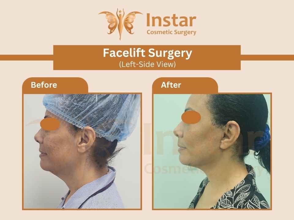 Facelift-Surgery-Left-Side View